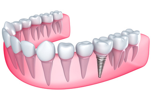 dental implant